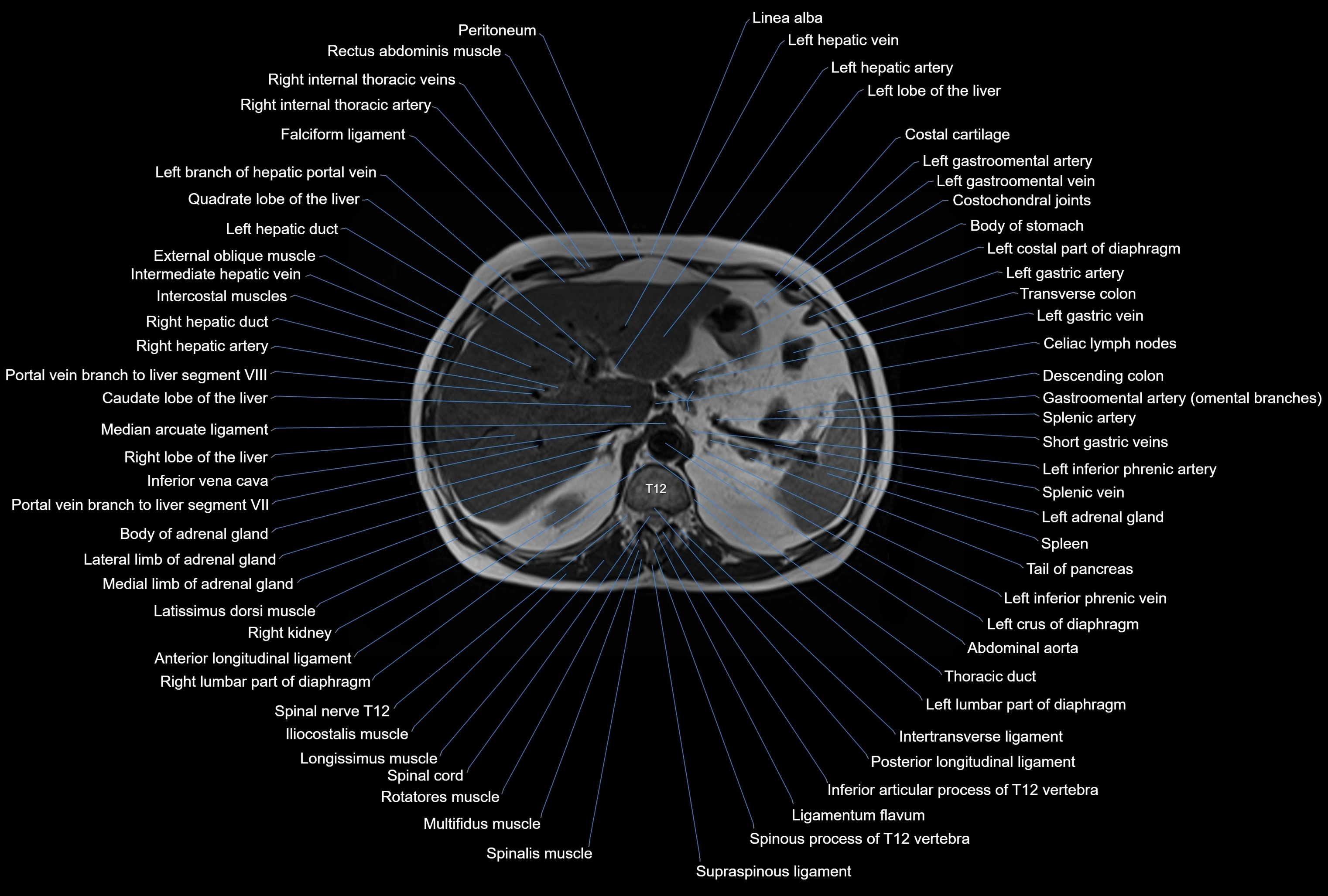 MRI Abdomen axial cross sectional anatomy radiology  image-img-00001-00013.webp